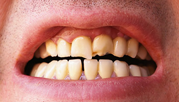 Misalignment and Bruxism Symptoms