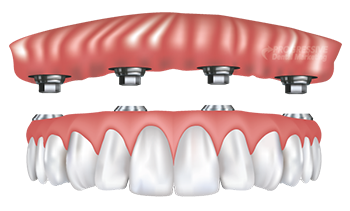 Dental Implant Supported Dentures