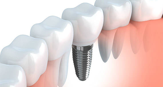 Dental Implants