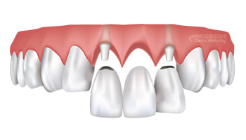 Smile Makeover Procedures