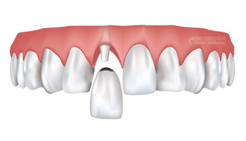 Smile Makeover Procedures